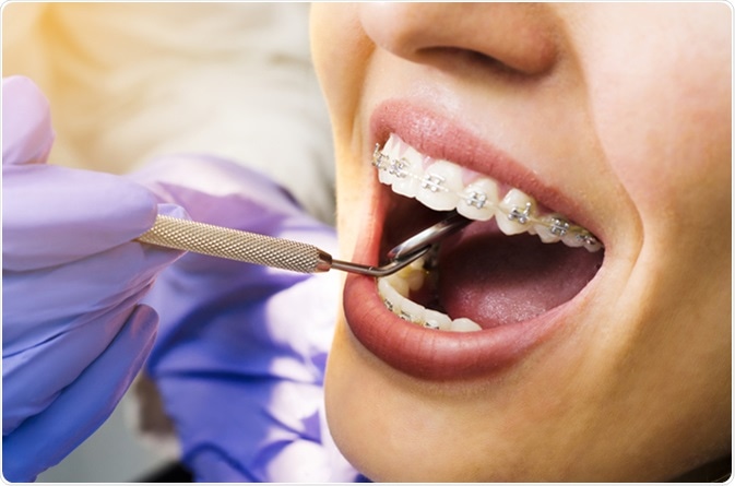 11 điều cần biết trước khi đi niềng răng