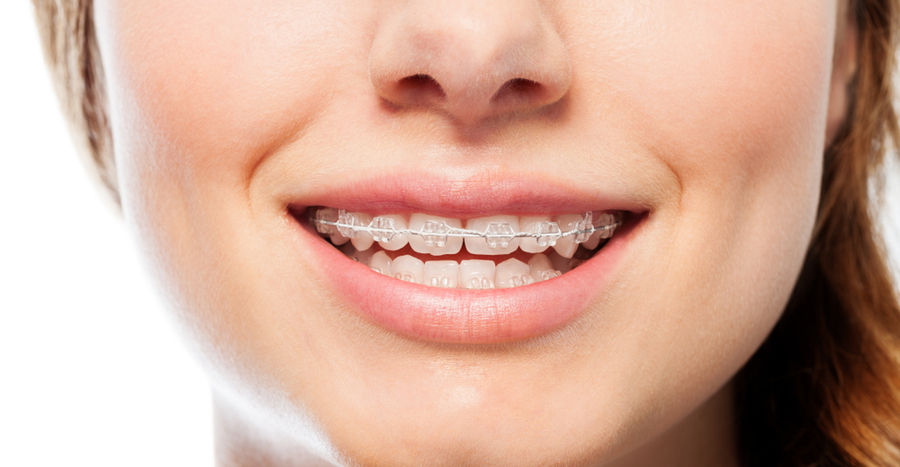 Niềng răng mắc cài sứ tốt nhất bằng mắc cài 3M Clarity™ ADVANCED