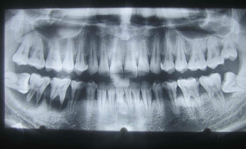 Tại sao phải nhổ răng khôn mọc lệch mọc ngầm