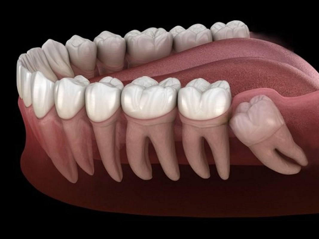 Răng khôn mọc ngầm và những biến chứng nguy hiểm nếu không nhổ sớm