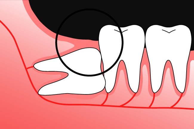 Răng khôn mọc lệch 90 độ: Các biến chứng - Phương pháp nhổ bỏ và lưu ý sau khi nhổ răng khôn