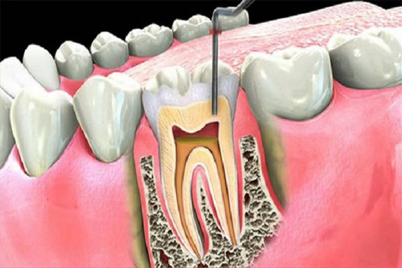 Điều trị tủy răng uy tín, phương pháp hiện đại tại Nha Khoa Hà Nội Seoul