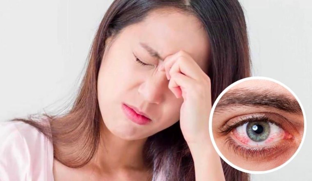 Đau mắt đỏ: Những loại thuốc nhỏ mắt bác sĩ khuyên không tự ý dùng