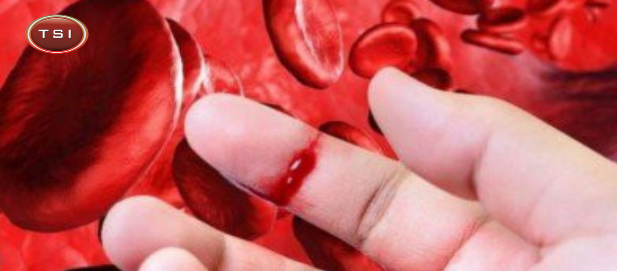 Bệnh máu khó đông Hemophilia A – nguyên nhân, chẩn đoán, triệu chứng và cách điều trị