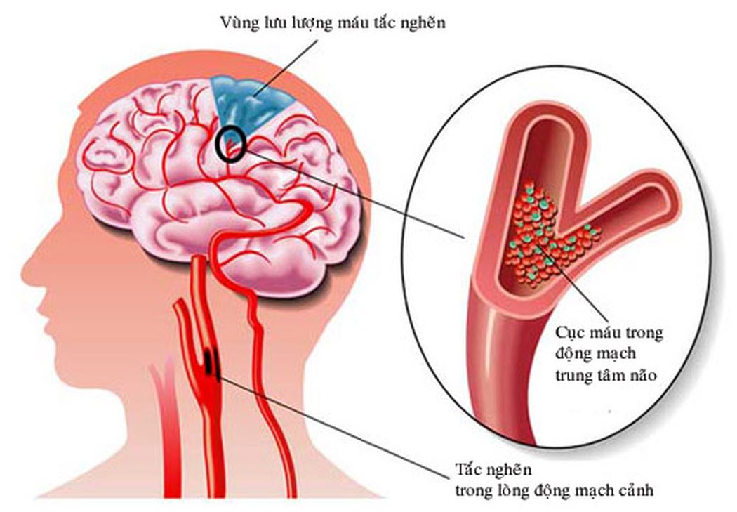 Bệnh thiếu máu não do tắc nghẽn mạch máu não