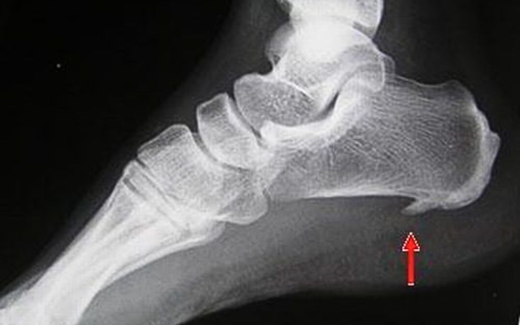 Bệnh gai gót chân là gì? Cách điều trị dứt điểm bệnh gai gót chân 1