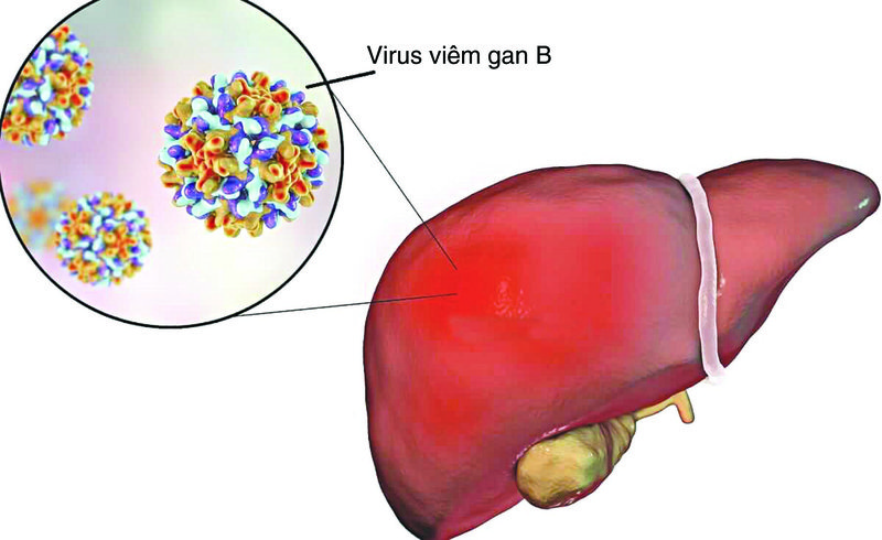 Viêm gan B cấp tính có sử dụng VBG Livseven được không?