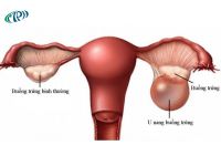 U nang buồng trứng: Nguyên nhân, dấu hiệu và cách điều trị