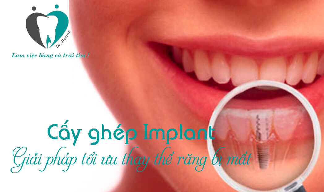Cấy ghép răng Implant giá bao nhiêu?