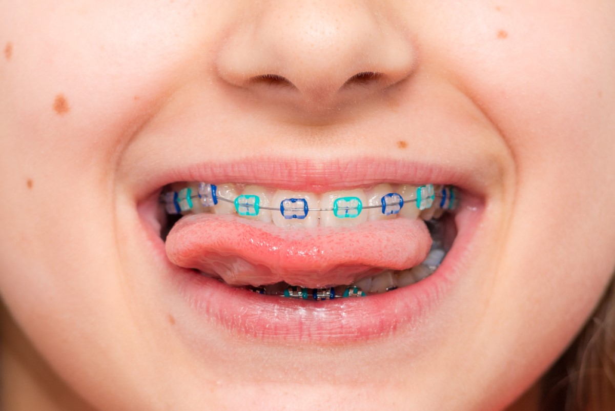 Hướng dẫn cơ bản về niềng răng cho trẻ em