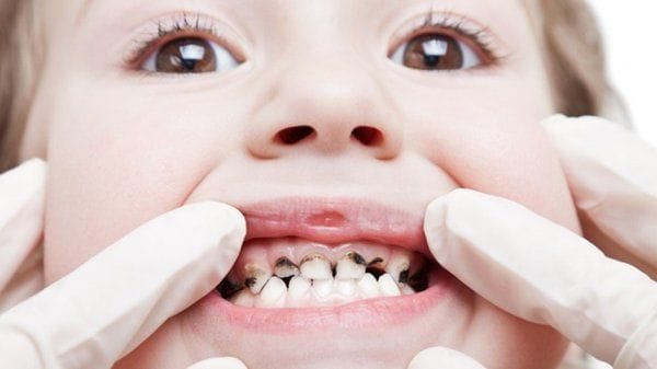 Nguyên nhân gây sâu răng?