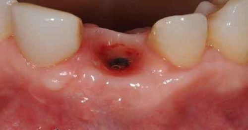 Biến chứng sau nhổ răng: Viêm ổ răng khô