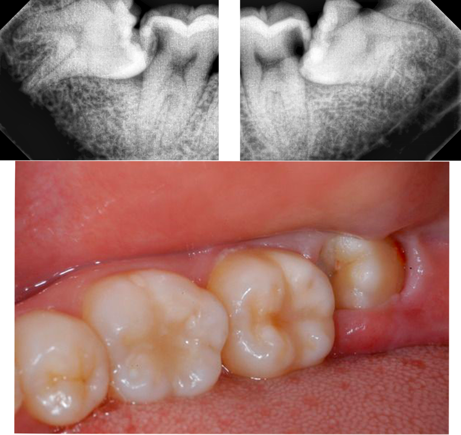 Răng khôn mọc lệch với những biến chứng nguy hiểm không ngờ tới