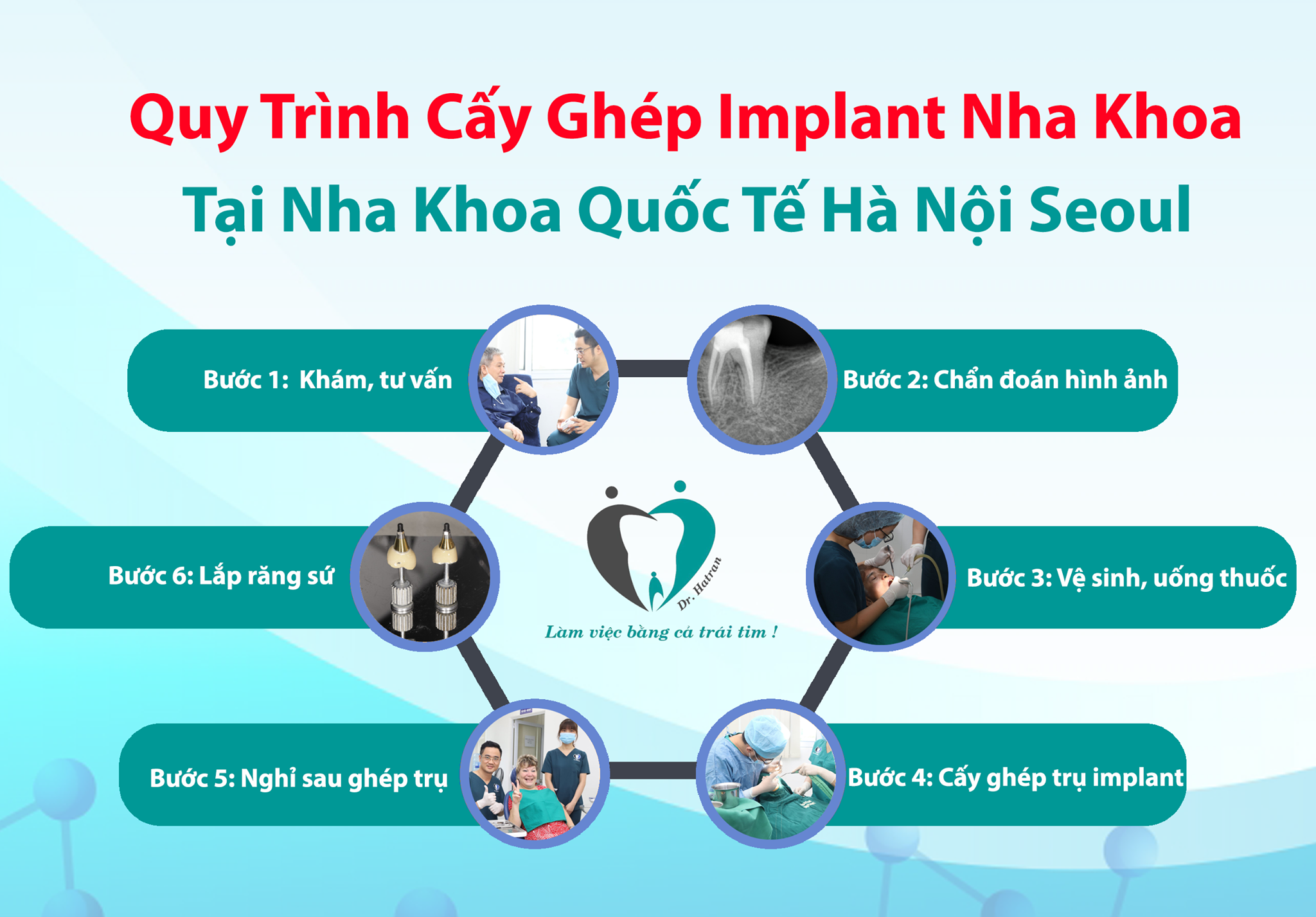 Quy trình cấy ghép implant nha khoa tại nha khoa quôc tế Hà Nội Seoul?