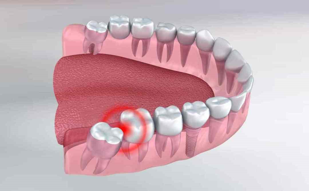 Các phương pháp chữa trị tự nhiên hiệu quả để xoa dịu cơn đau răng khôn