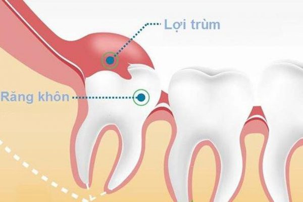 Đau răng khôn là gì?