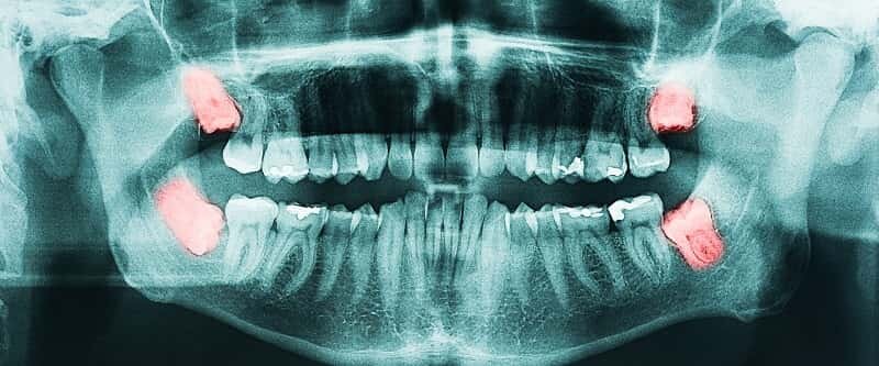 Đau khi mọc răng khôn, Cách xử trí từ nhà cho đến khi bạn có thể gặp nha sĩ
