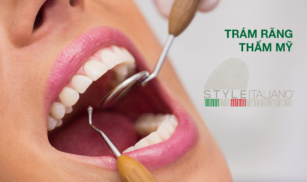 Trám răng thẩm mỹ Style Italiano - Phương pháp phục hồi răng sứt, mẻ, thưa