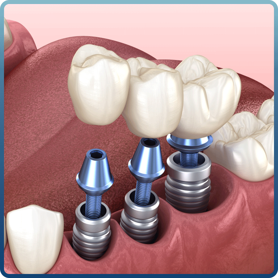 Mất 2 răng liền kề thì nên phục hồi bằng phương pháp nào?