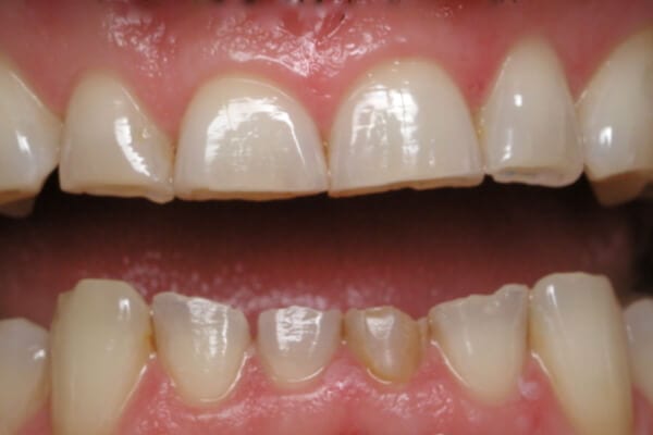 Mòn mặt răng: Nguyên nhân và cách điều trị như thế nào?