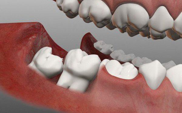 Vì sao chúng ta lại có răng khôn? Có nên nhổ răng khôn không?