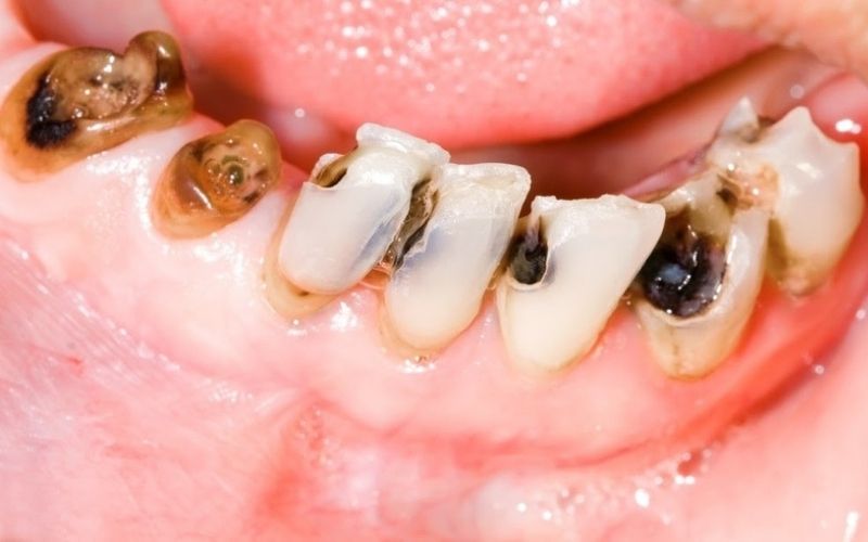 Sâu răng: Nguyên nhân- dấu hiệu nhận biết và phương pháp điều trị hiệu quả