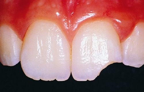 Sứt mẻ răng: Nguyên nhân - dấu hiệu nhận biết và một số phương pháp điều trị răng sứt mẻ