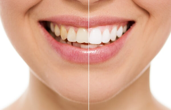 Những phương pháp điều trị răng đổi màu gây mất thẩm mỹ đơn giản và hiệu quả