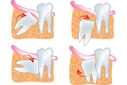 Những biến chứng nguy hiểm do răng khôn mọc lệch gây đau