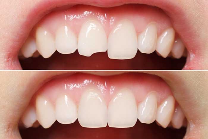 Trám thẩm mỹ răng cửa cho các trường hợp: Răng thưa, răng cửa bị sâu, sứt mẻ răng, mòn cổ răng cửa
