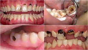 ​Sâu răng nặng thì xử lý như thế nào?