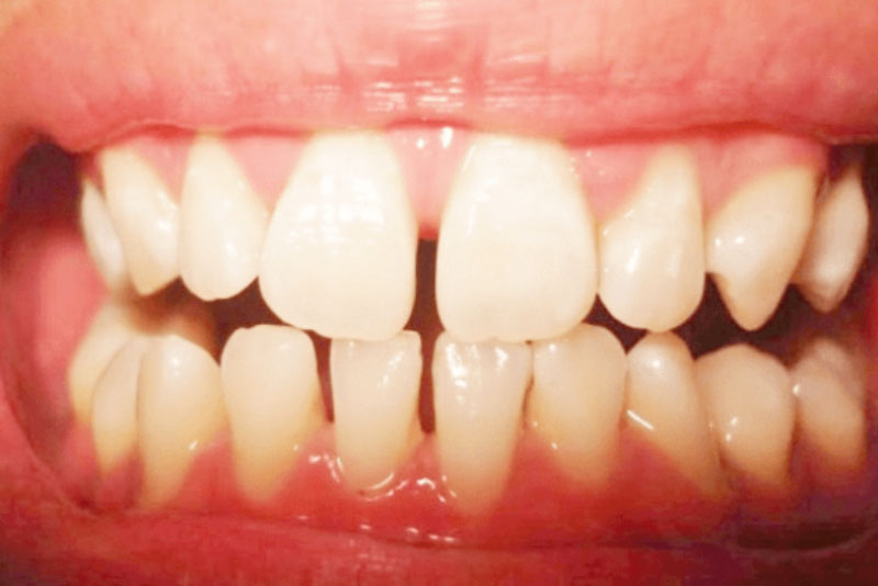 Xử lý tình trạng răng thưa bằng phương pháp nào hiệu quả và tiết kiệm nhất?
