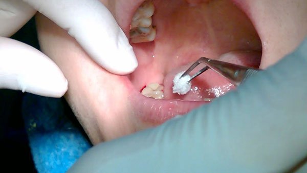 ​Nhổ răng khôn có nguy hiểm không?