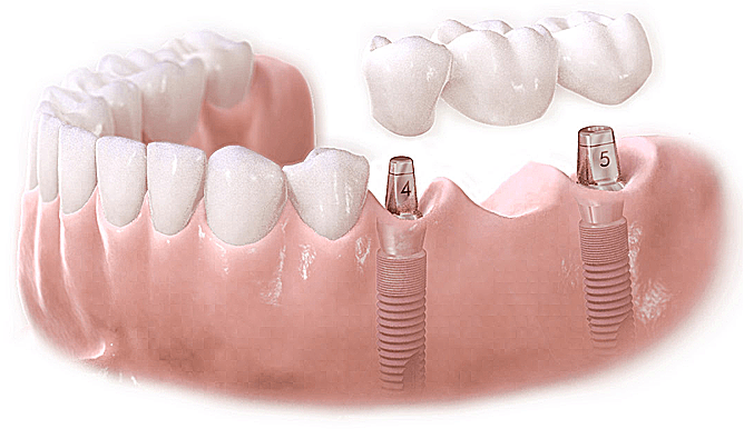 Cấy ghép implant răng hàm - giải pháp phục hồi tình trạng mất răng hàm
