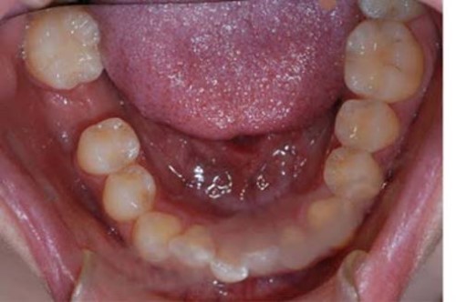 Mất răng hàm: Tác hại và giải pháp phục hồi