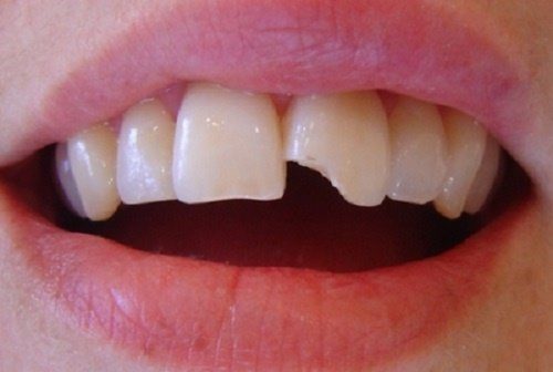 Răng sứt mẻ: Nguyên nhân và phương pháp điều trị phục hồi